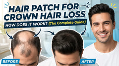 Hair Patch for Crown Hair Loss: How Does It Work?