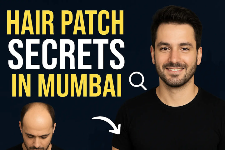 Everything You Need to Know About Hair Patches in Mumbai