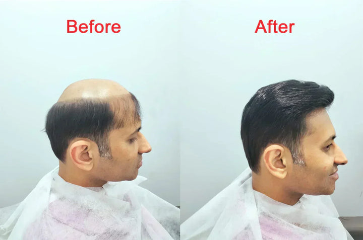 Natural Look, Zero Surgery: The Rise of Human Hair Patches in Mumbai