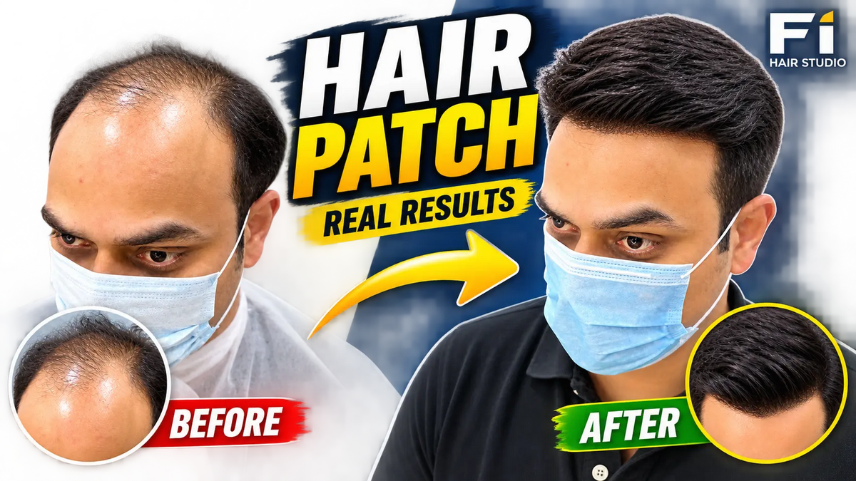 How Modern Hair Patches Help Men Reclaim Their Signature Look