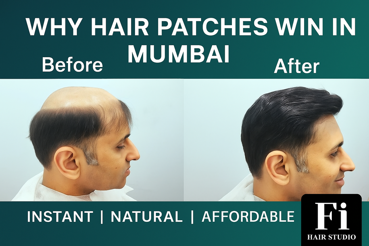 Why Hair Patches Beat Painful Transplants in Mumbai