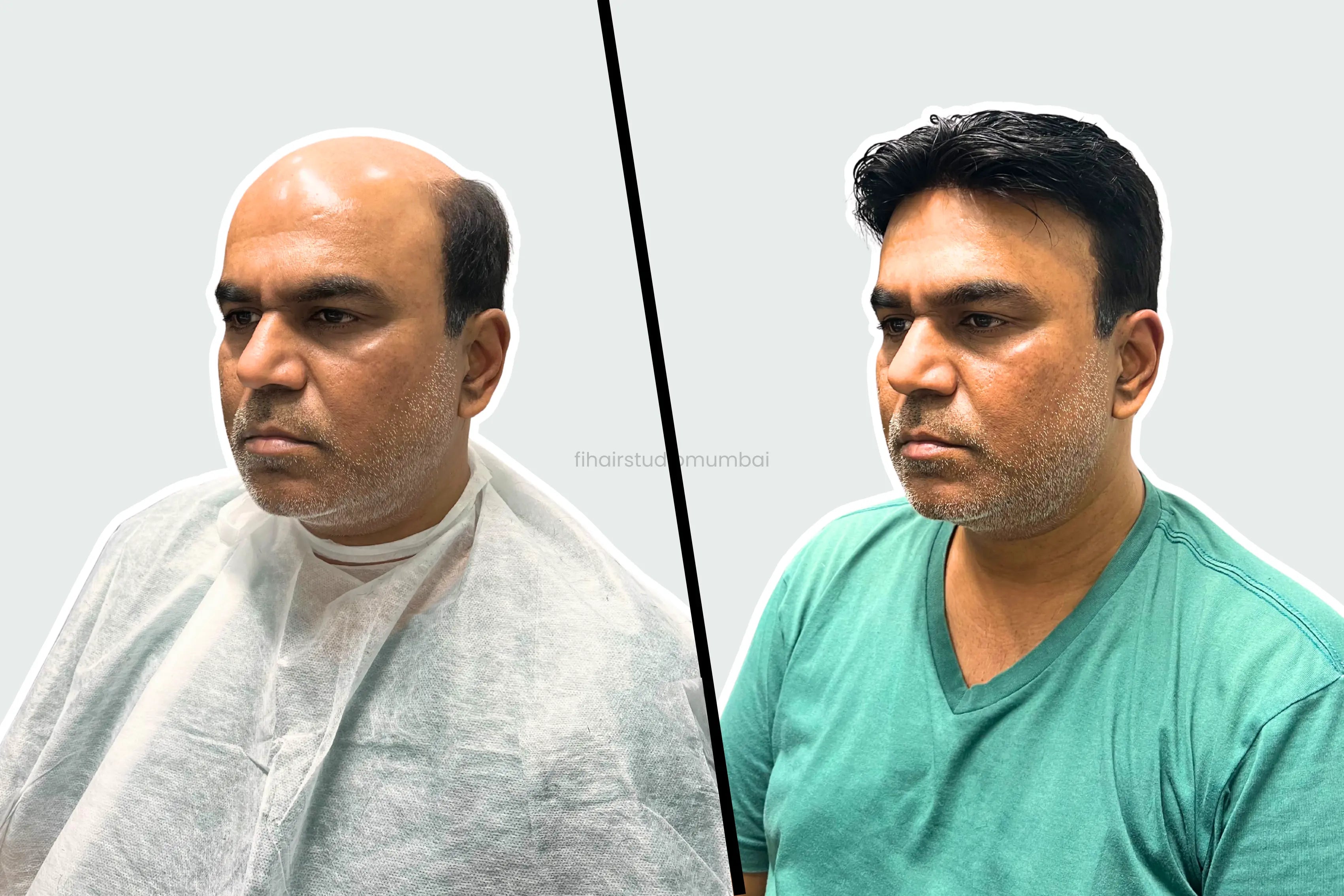 Before and after customized hair patch transformation by Fi Hair Studio in Mumbai showing natural non-surgical hair replacement for baldness