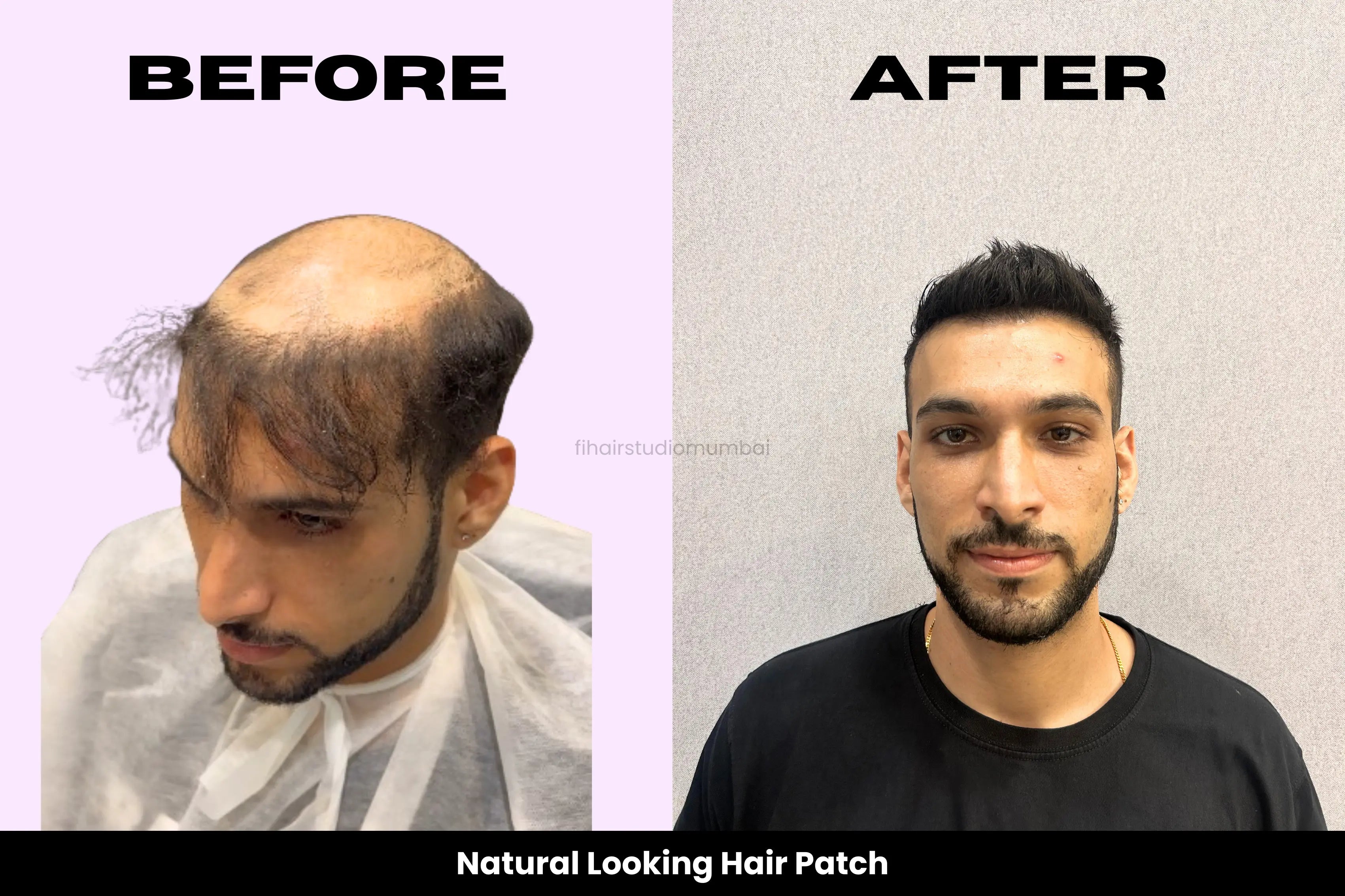 About Our Hair Patch Service