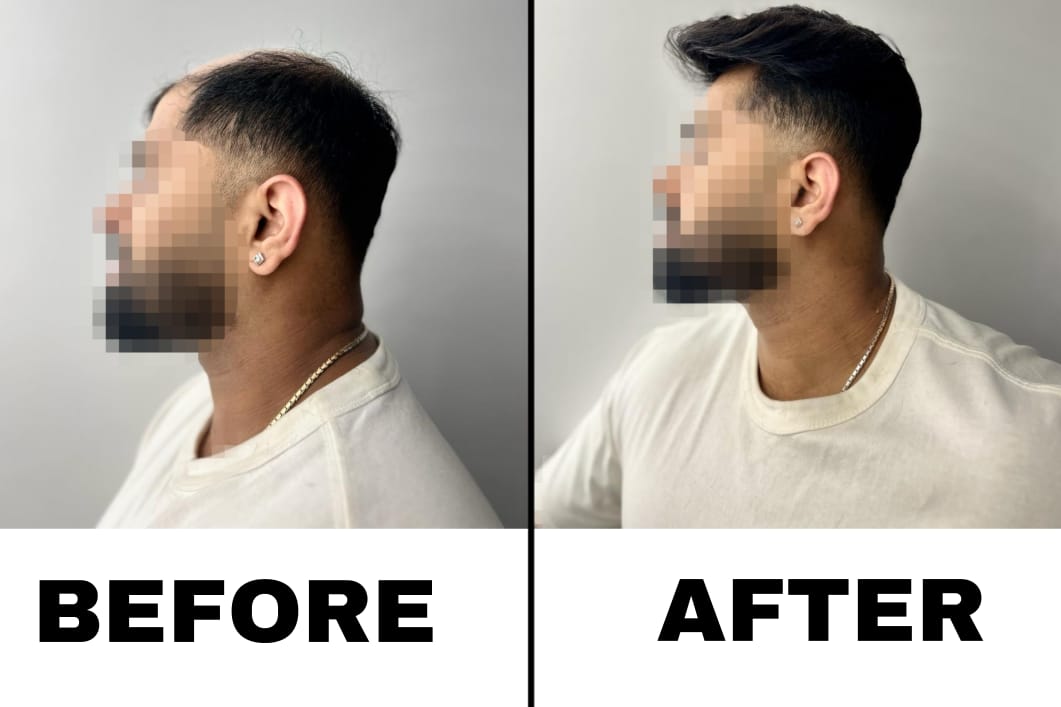 non surgical hair replacement 1