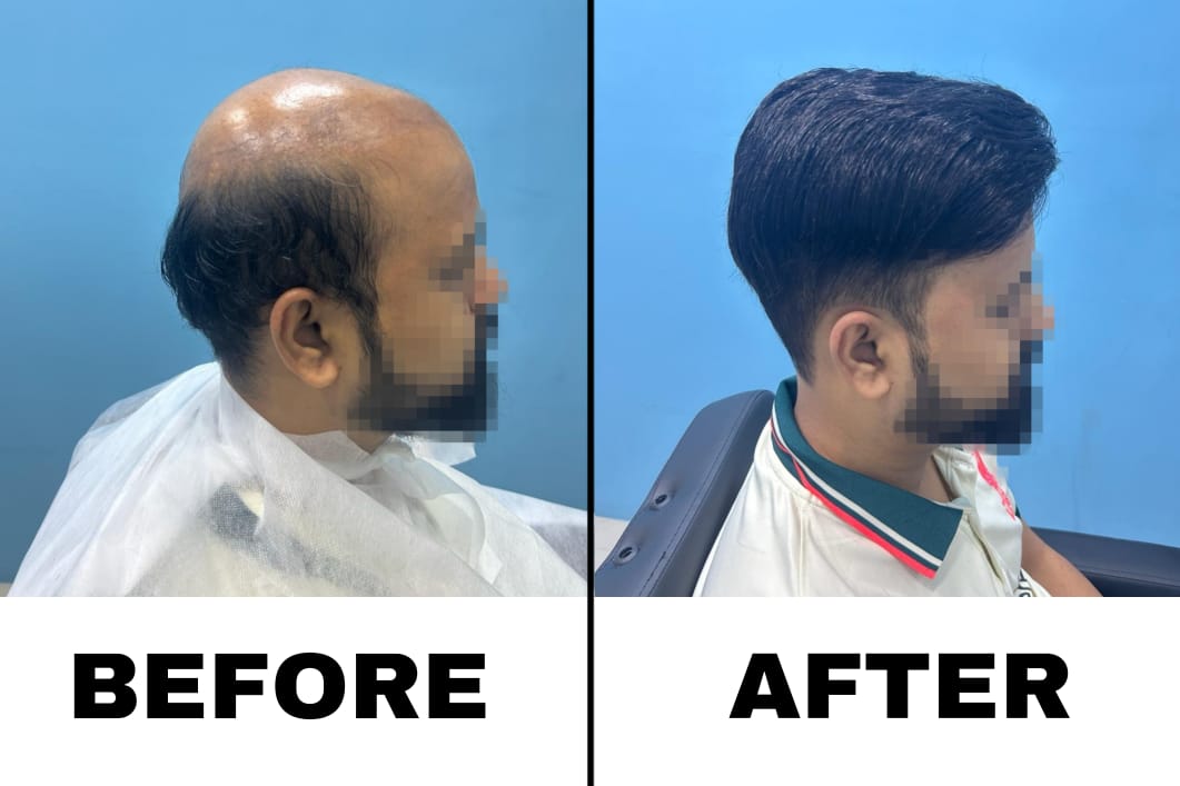 non surgical hair replacement 5