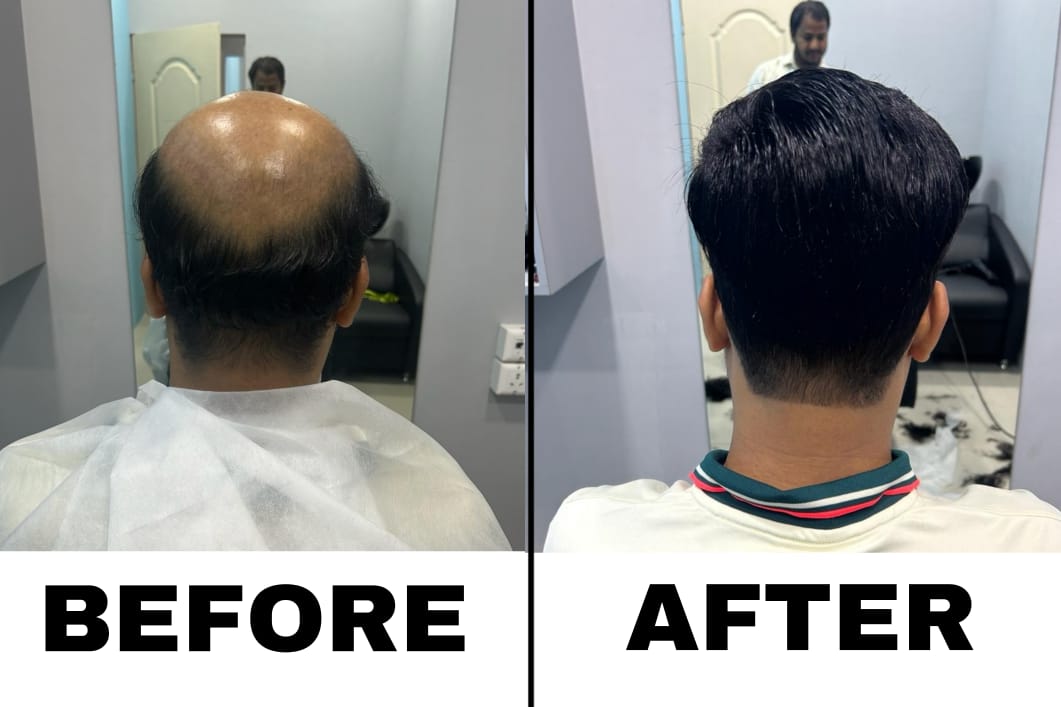 non surgical hair replacement 6