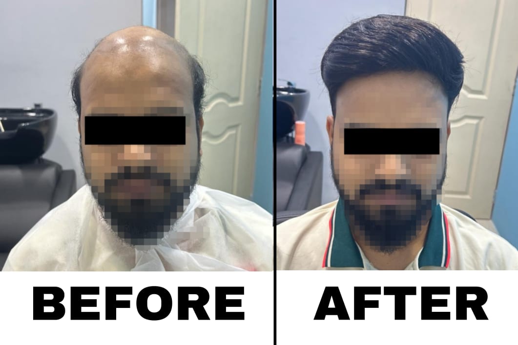 non surgical hair replacement 7