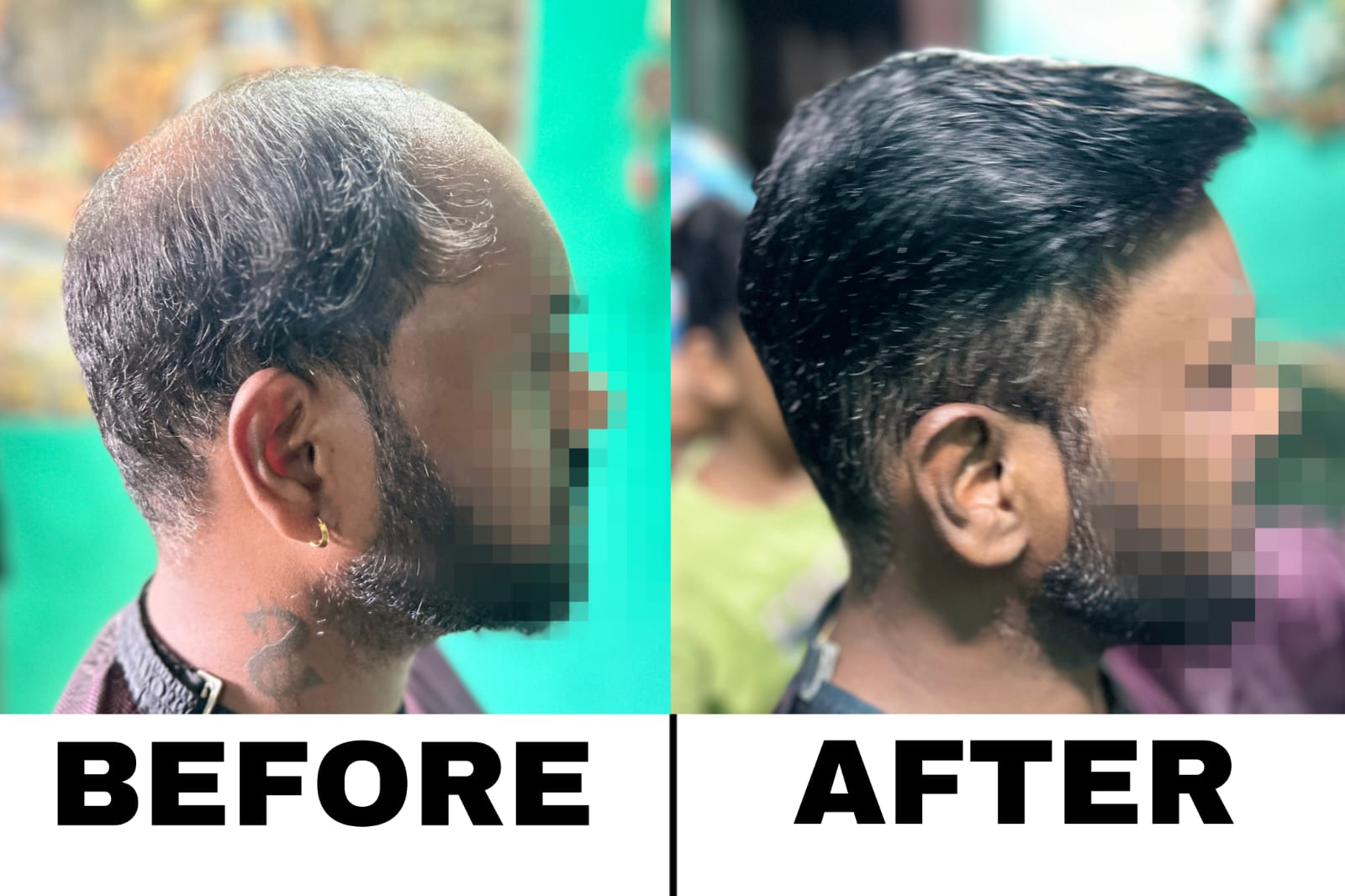 NON SURGICAL HAIR REPLACEMENT